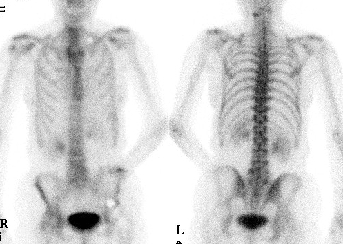 Bone Scan Normal Adult